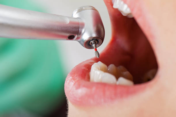 Best Emergency Wisdom Teeth Removal in San Felipe Pueblo, NM